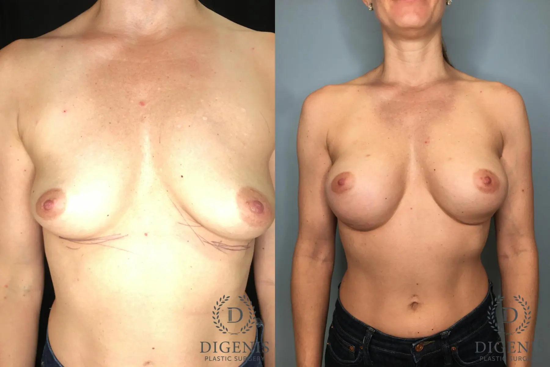 Breast Augmentation: Patient 29 - Before and After  