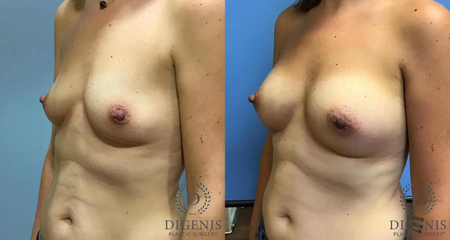 Breast Augmentation: Patient 12 - Before and After 4