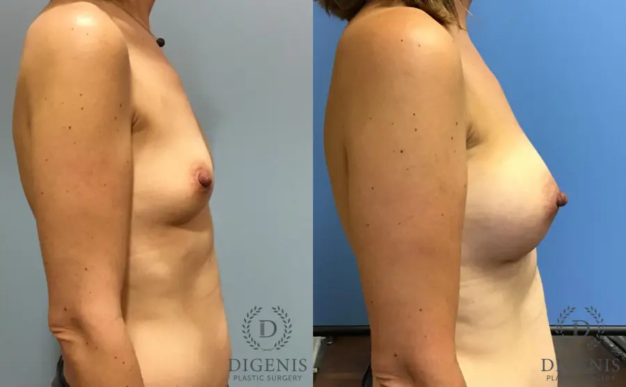 Breast Augmentation: Patient 12 - Before and After 3