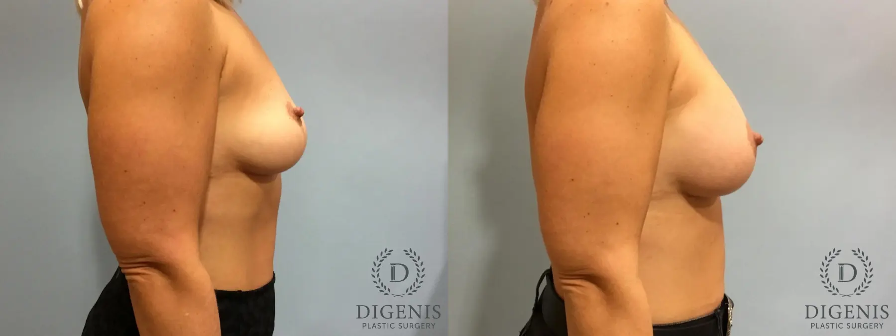 Breast Augmentation: Patient 13 - Before and After 3