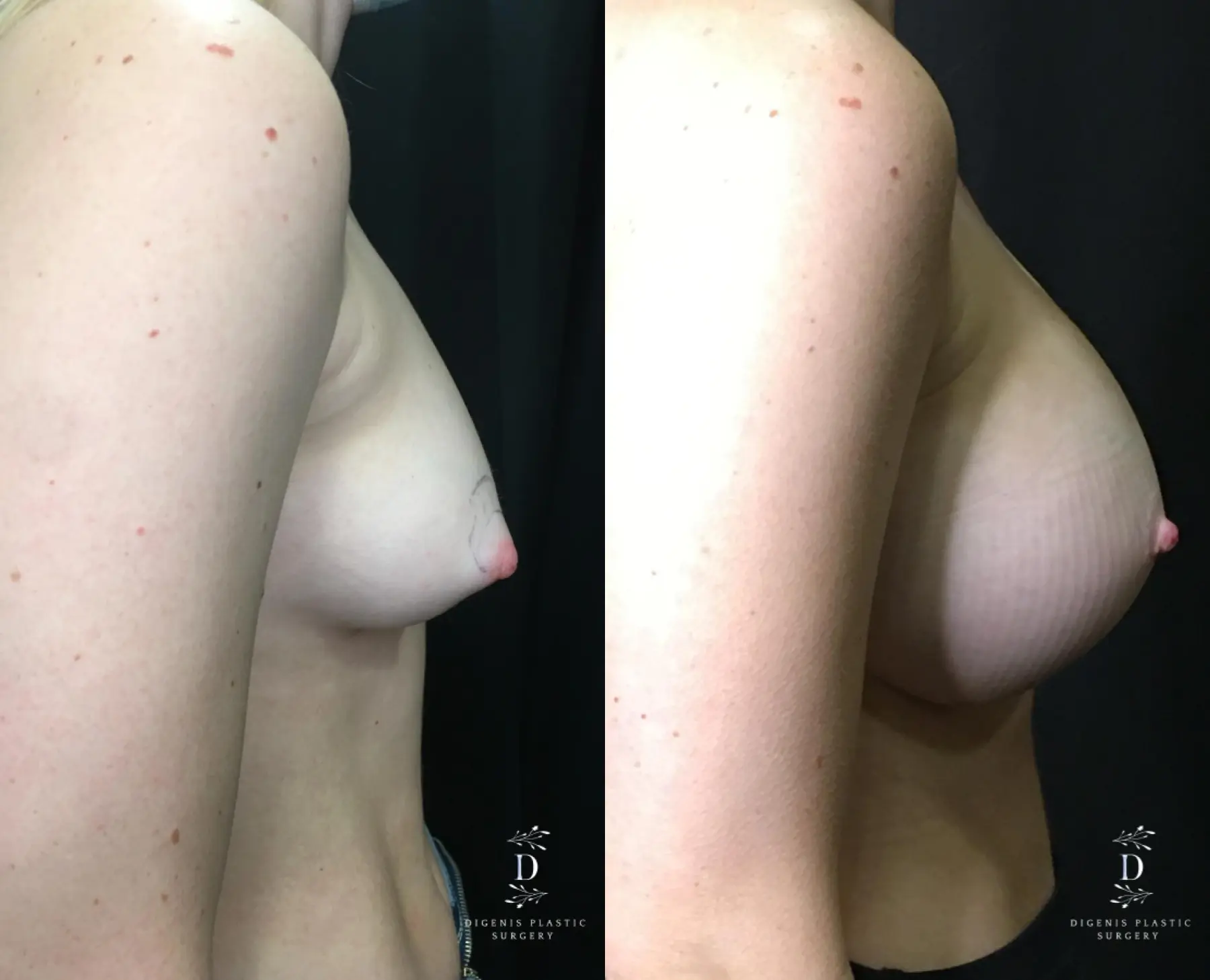 Breast Augmentation: Patient 25 - Before and After 3