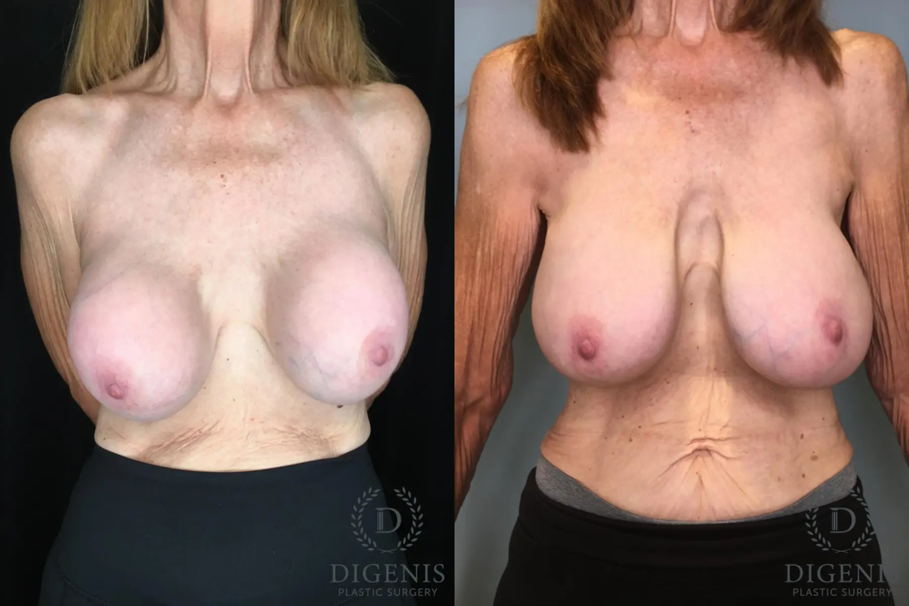 Breast Implant Exchange: Patient 6 - Before and After 1