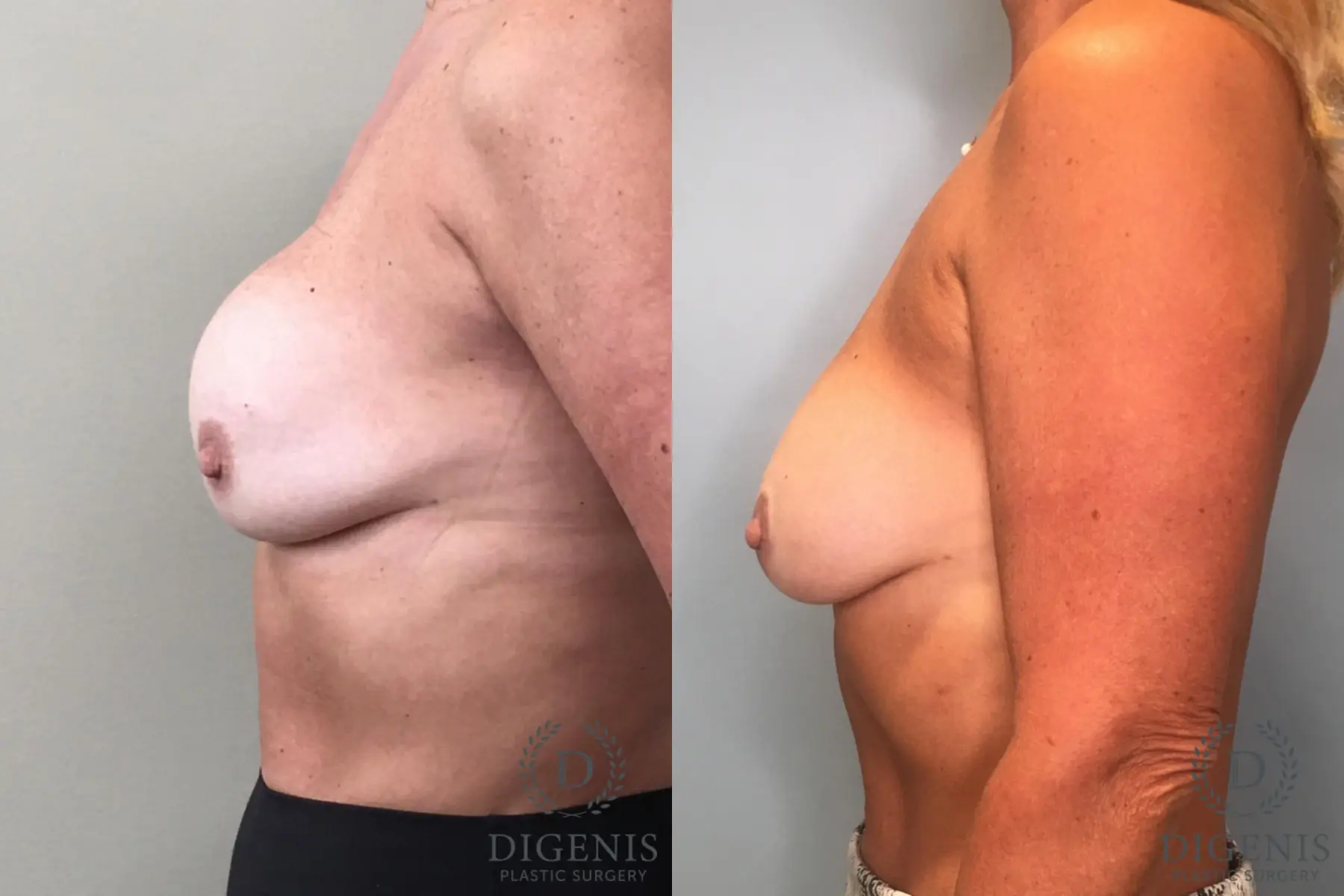 Breast Implant Exchange: Patient 2 - Before and After 3