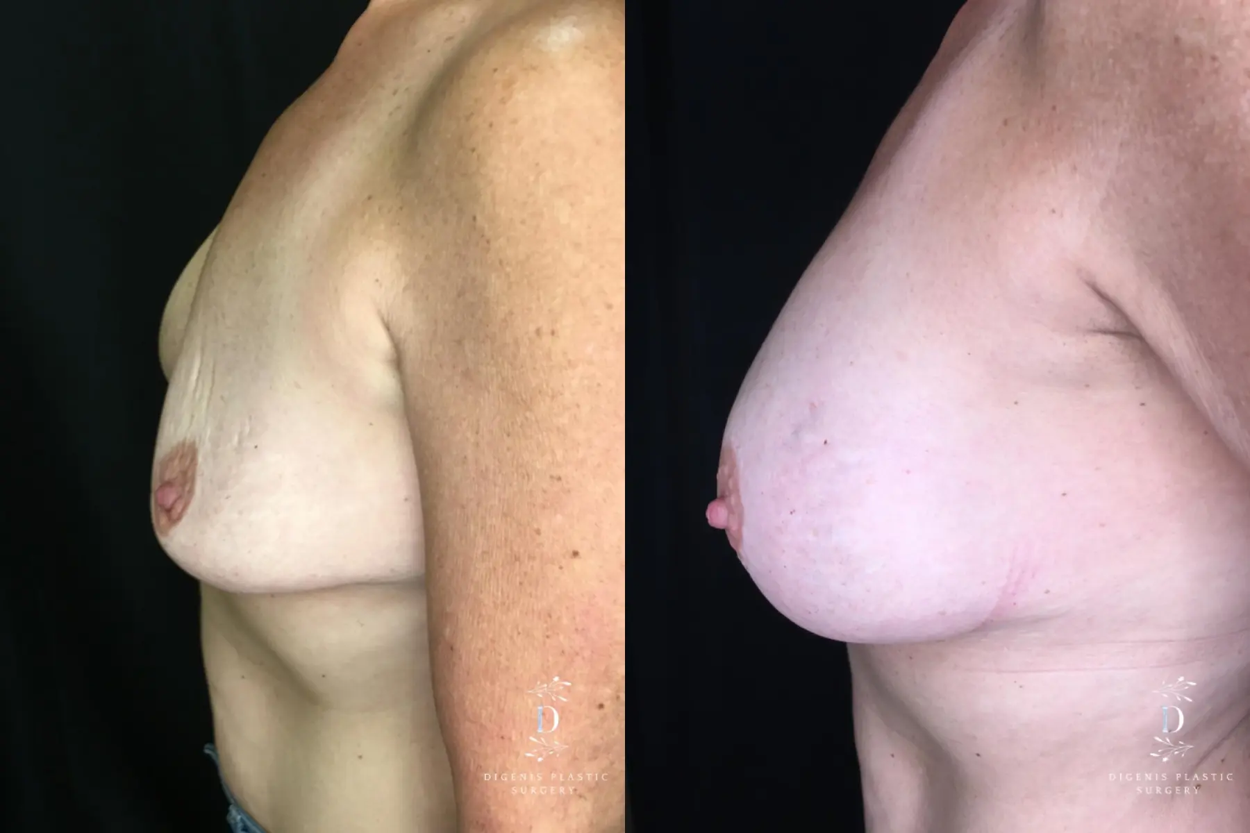 Breast Implant Exchange: Patient 3 - Before and After 5