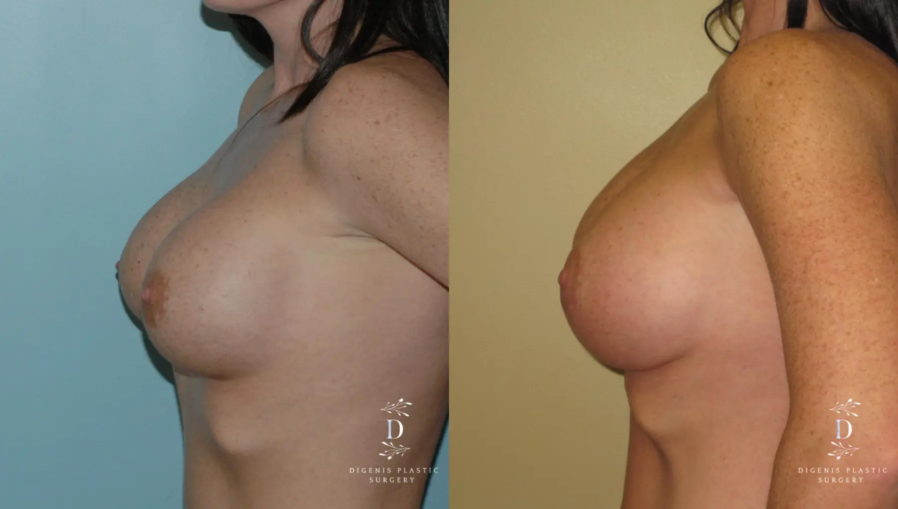 Breast Implant Exchange: Patient 1 - Before and After 3