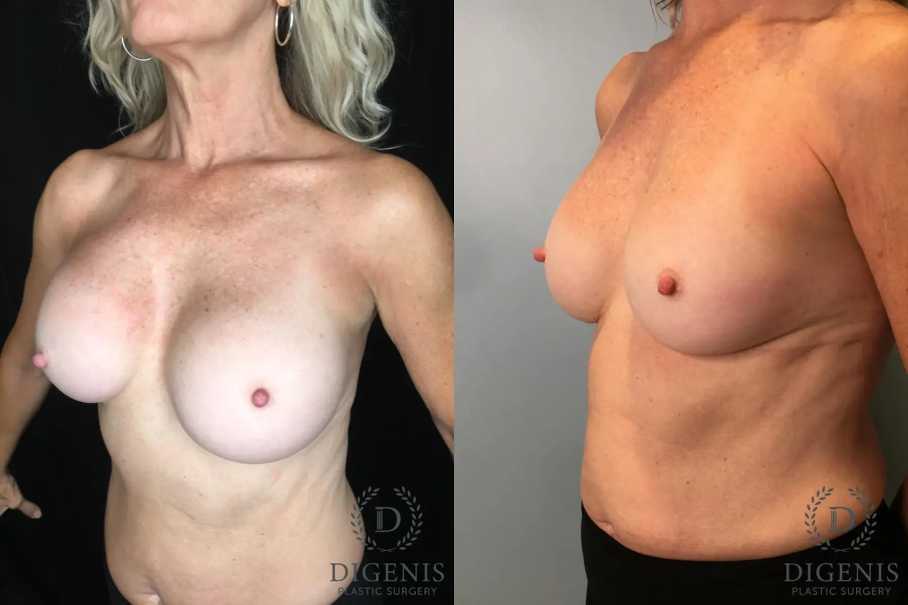 Breast Implant Exchange: Patient 5 - Before and After 4