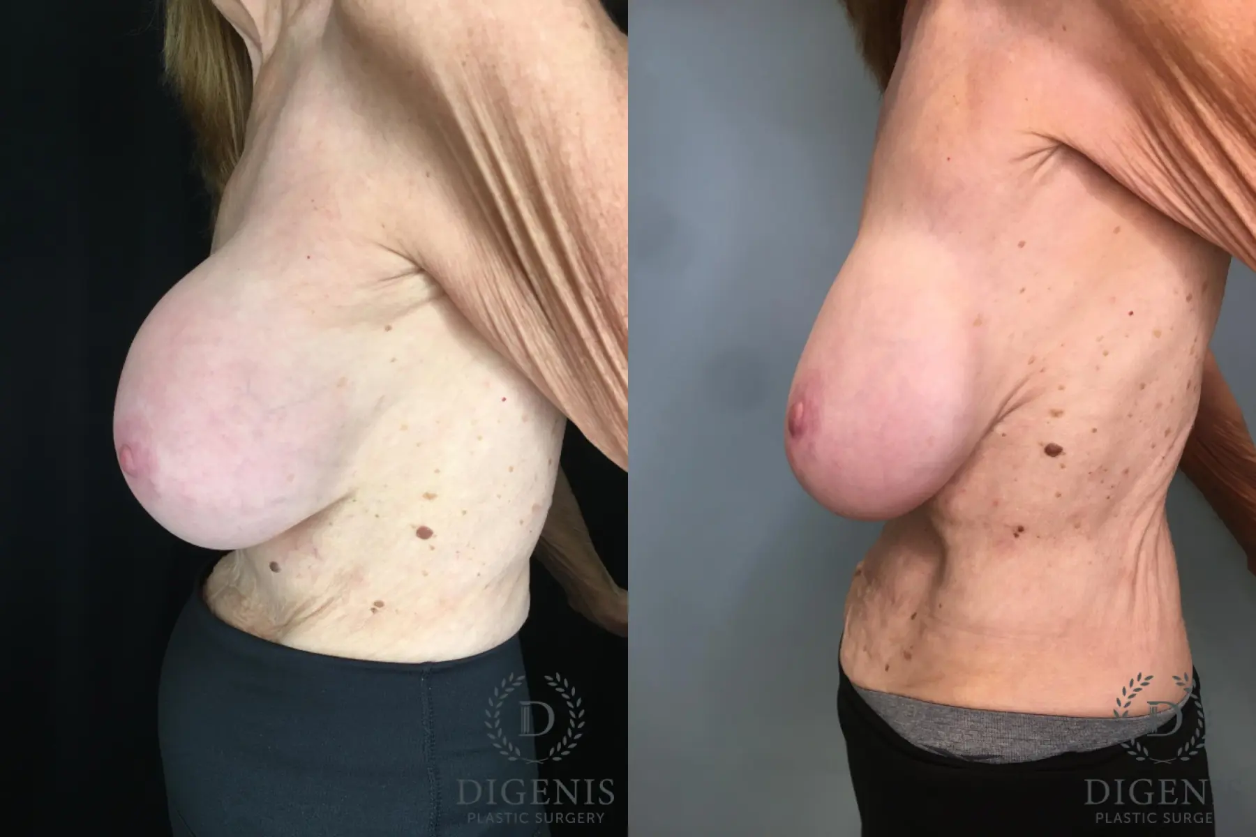 Breast Implant Exchange: Patient 6 - Before and After 3