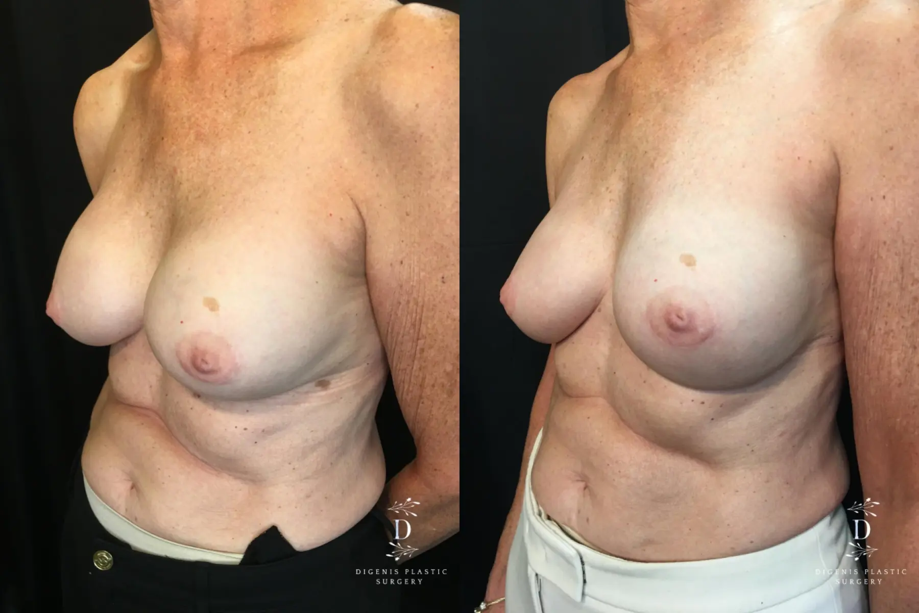 Breast Implant Exchange: Patient 3 - Before and After 4