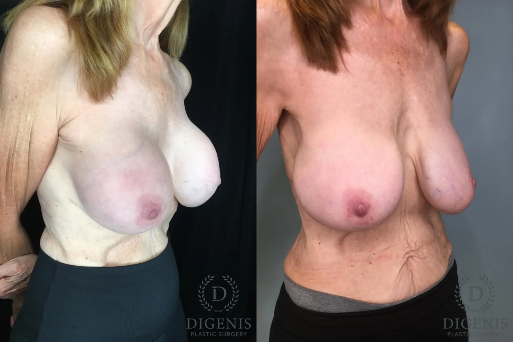 Breast Implant Exchange: Patient 6 - Before and After 4