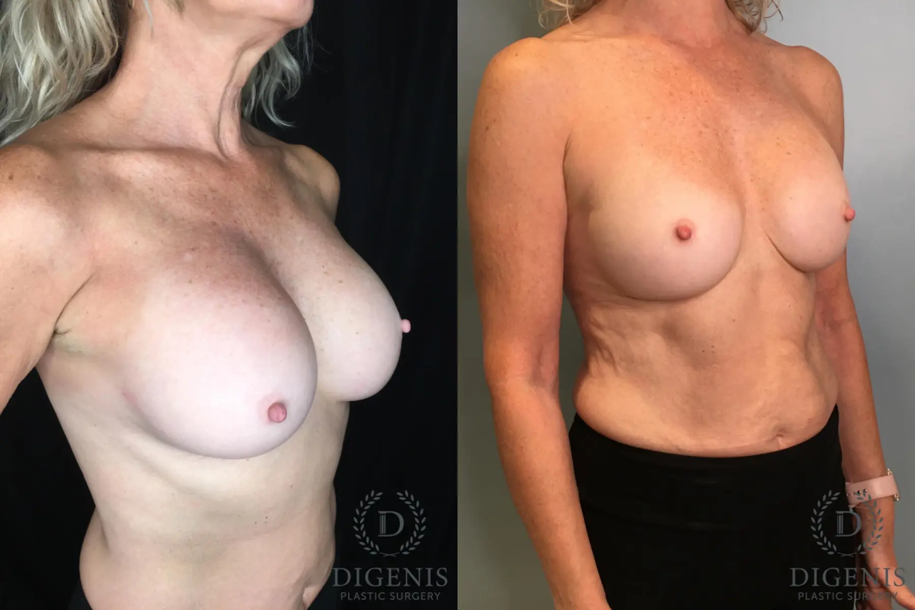 Breast Implant Exchange: Patient 5 - Before and After 2