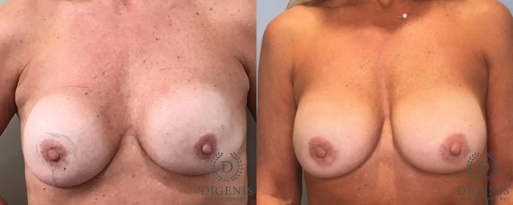 Breast Implant Exchange: Patient 3 - Before and After  