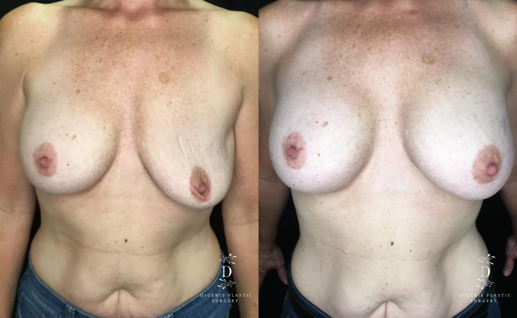 Breast Implant Exchange: Patient 3 - Before and After  