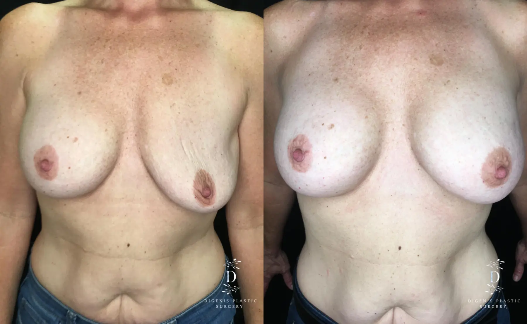 Breast Implant Exchange: Patient 4 - Before and After  