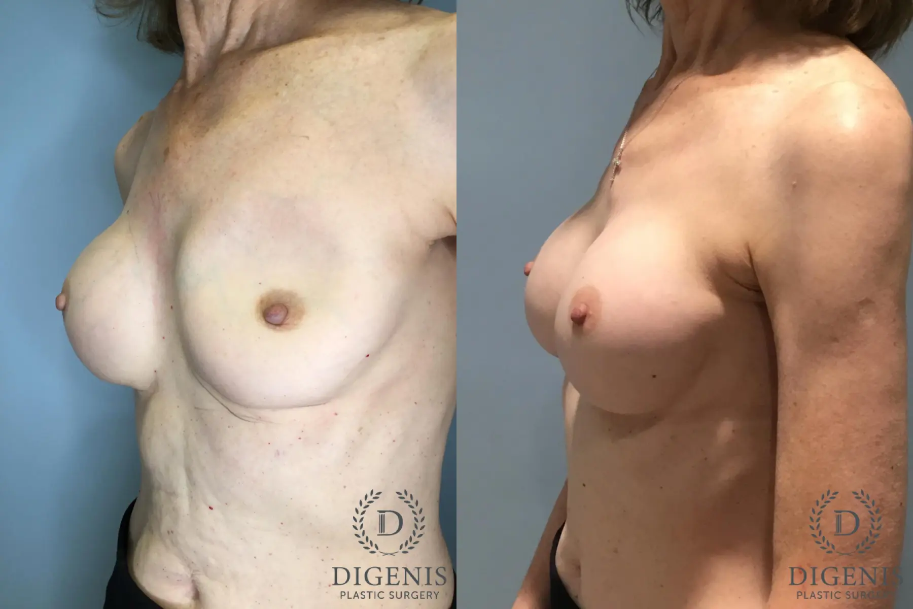 Breast Implant Exchange: Patient 1 - Before and After 2