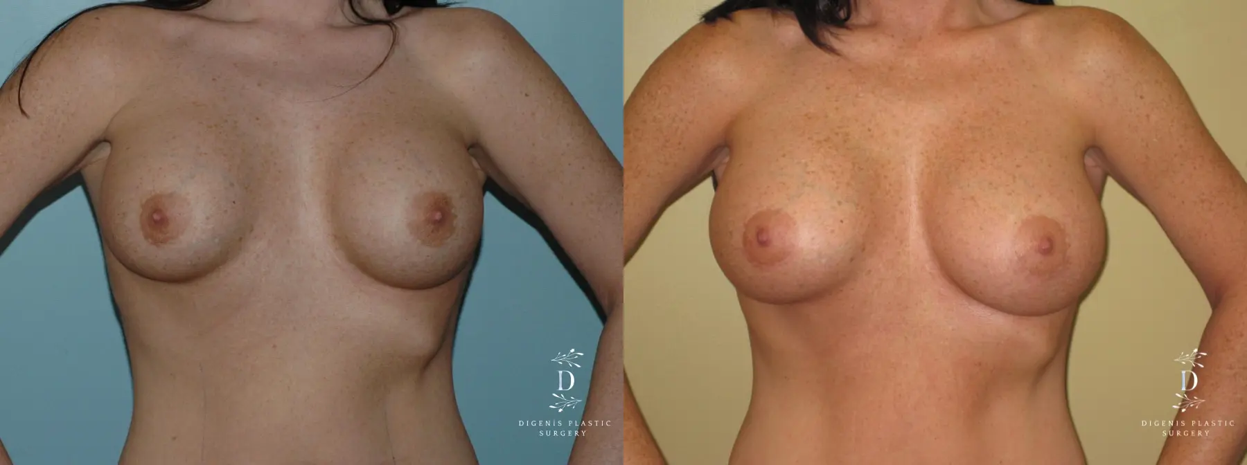 Breast Implant Exchange: Patient 1 - Before and After 1