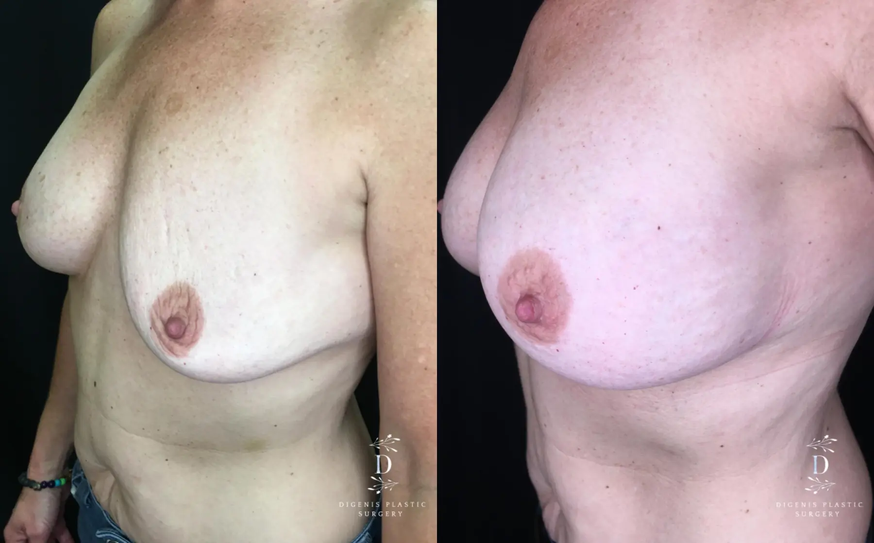 Breast Implant Exchange: Patient 3 - Before and After 4