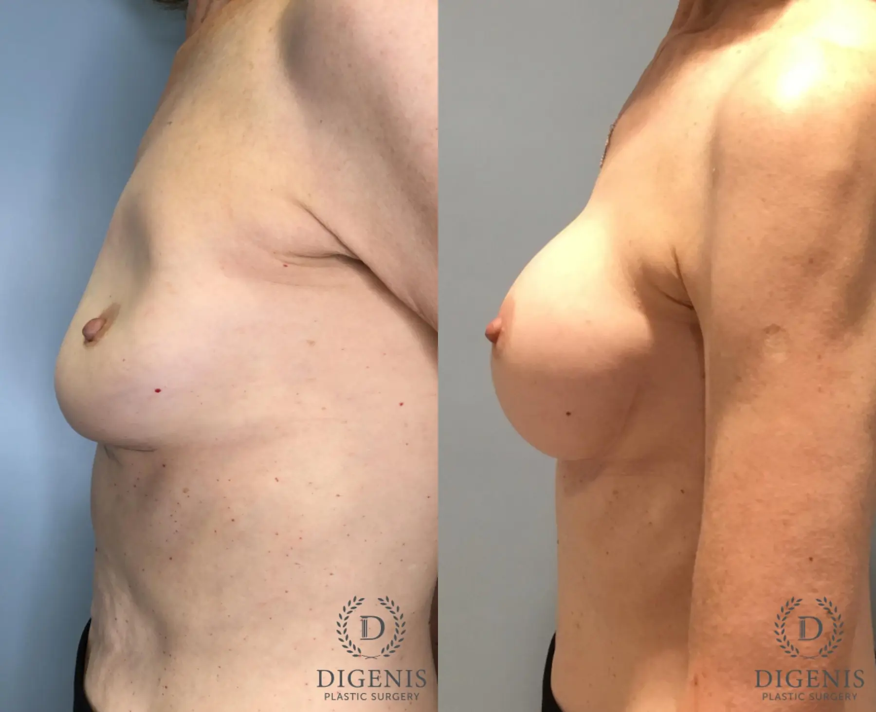 Breast Implant Exchange: Patient 1 - Before and After 3