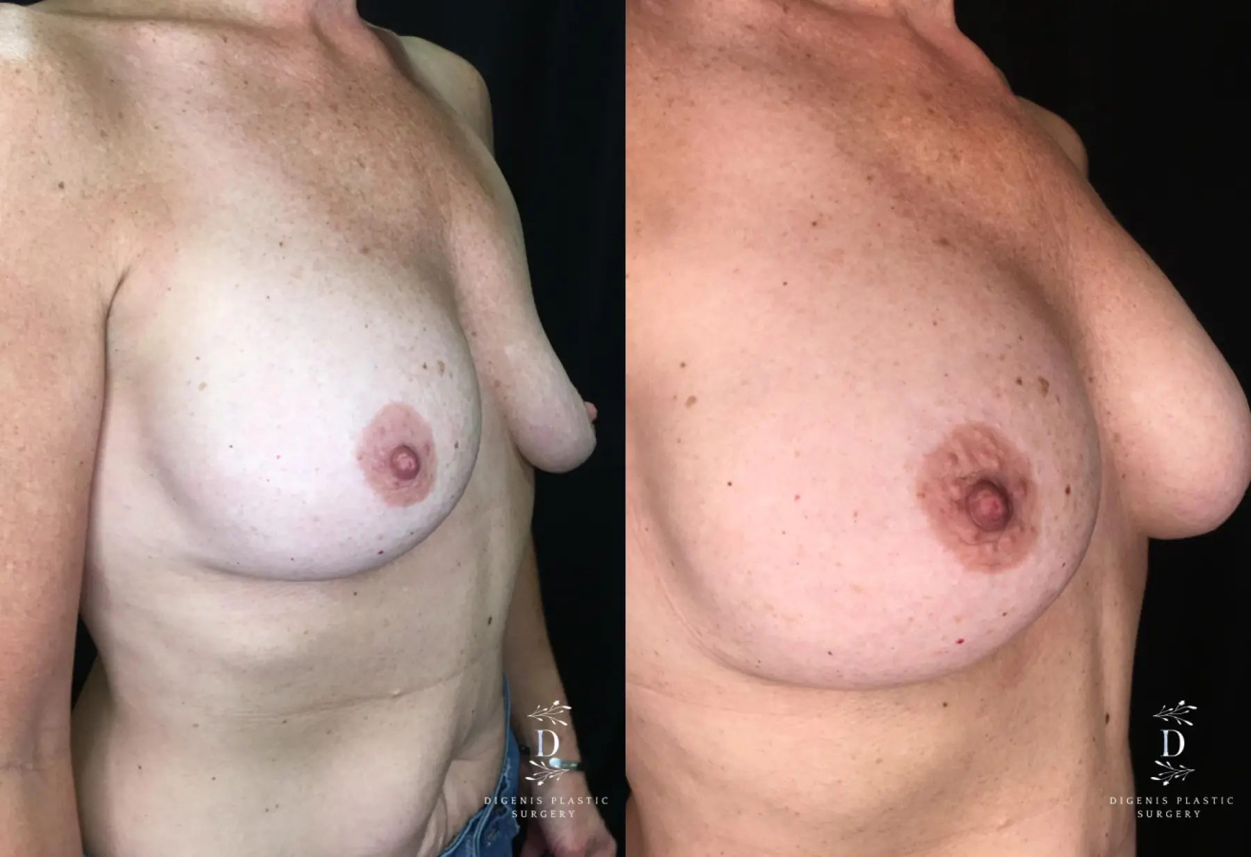 Breast Implant Exchange: Patient 4 - Before and After 2