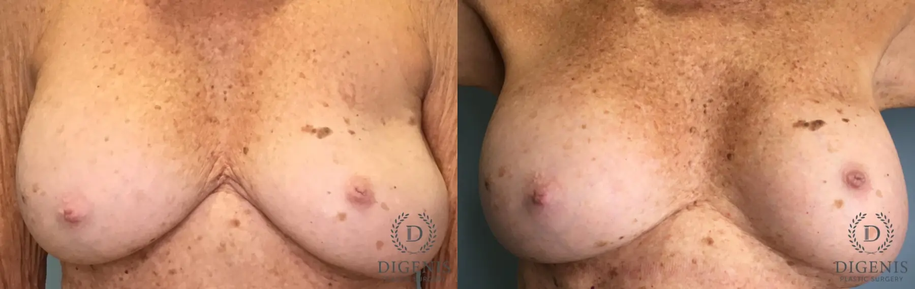 Breast Implant Exchange: Patient 12 - Before and After  