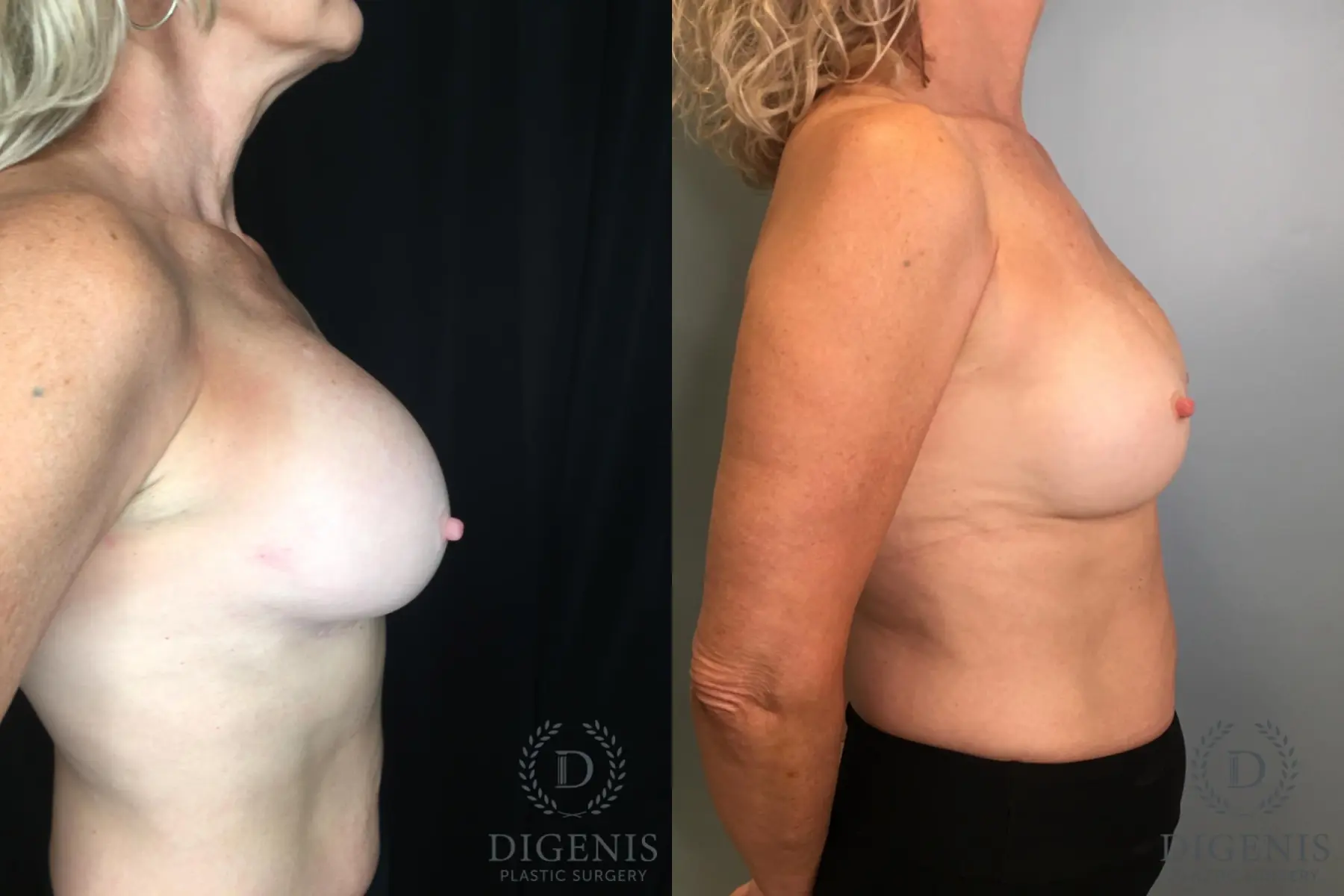 Breast Implant Exchange: Patient 5 - Before and After 5