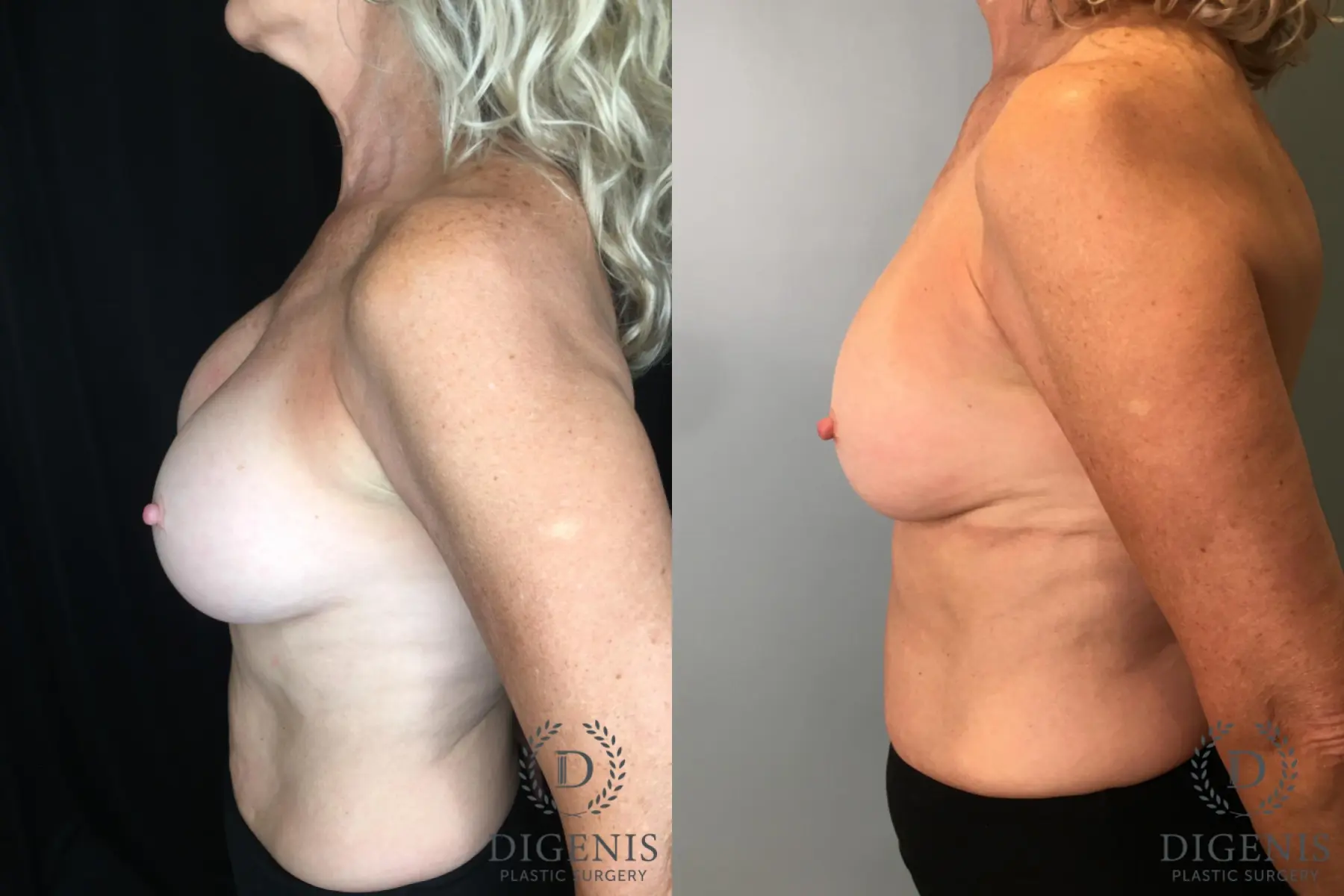 Breast Implant Exchange: Patient 5 - Before and After 3