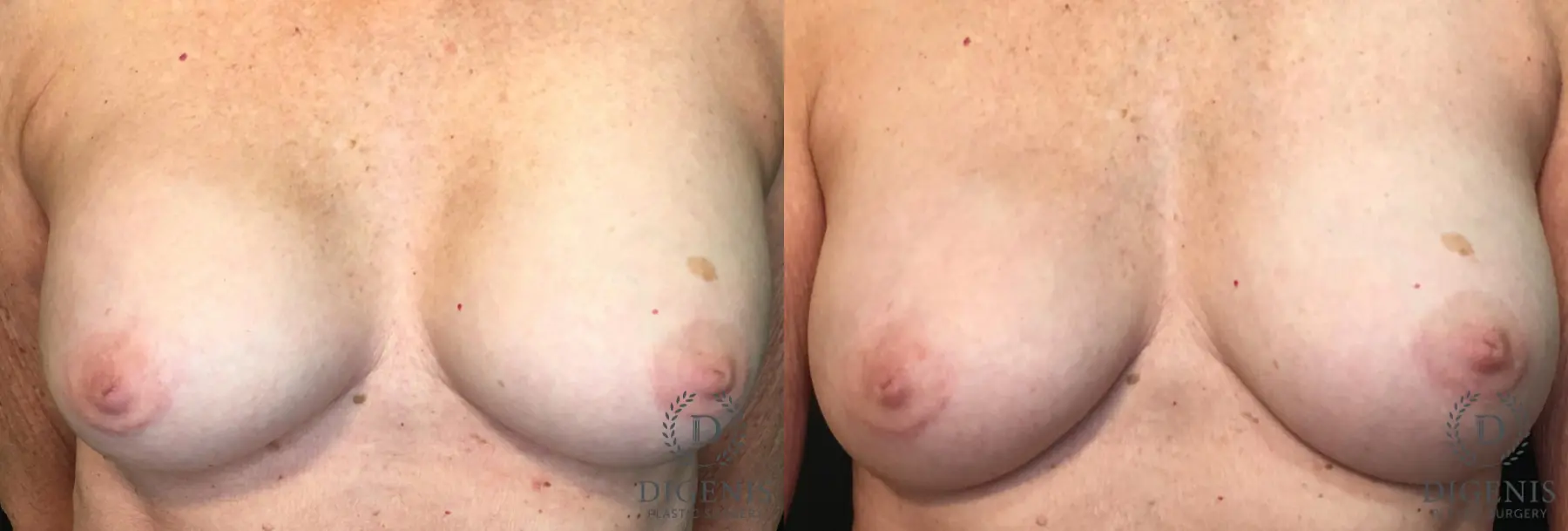 Breast Implant Exchange: Patient 3 - Before and After  