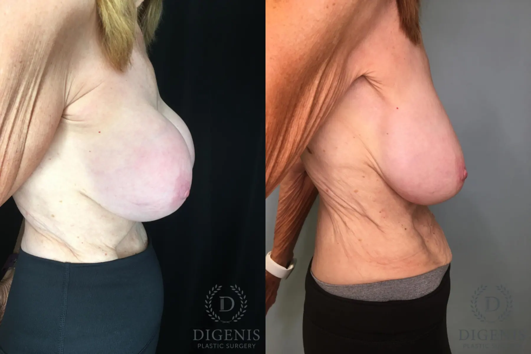 Breast Implant Exchange: Patient 6 - Before and After 5