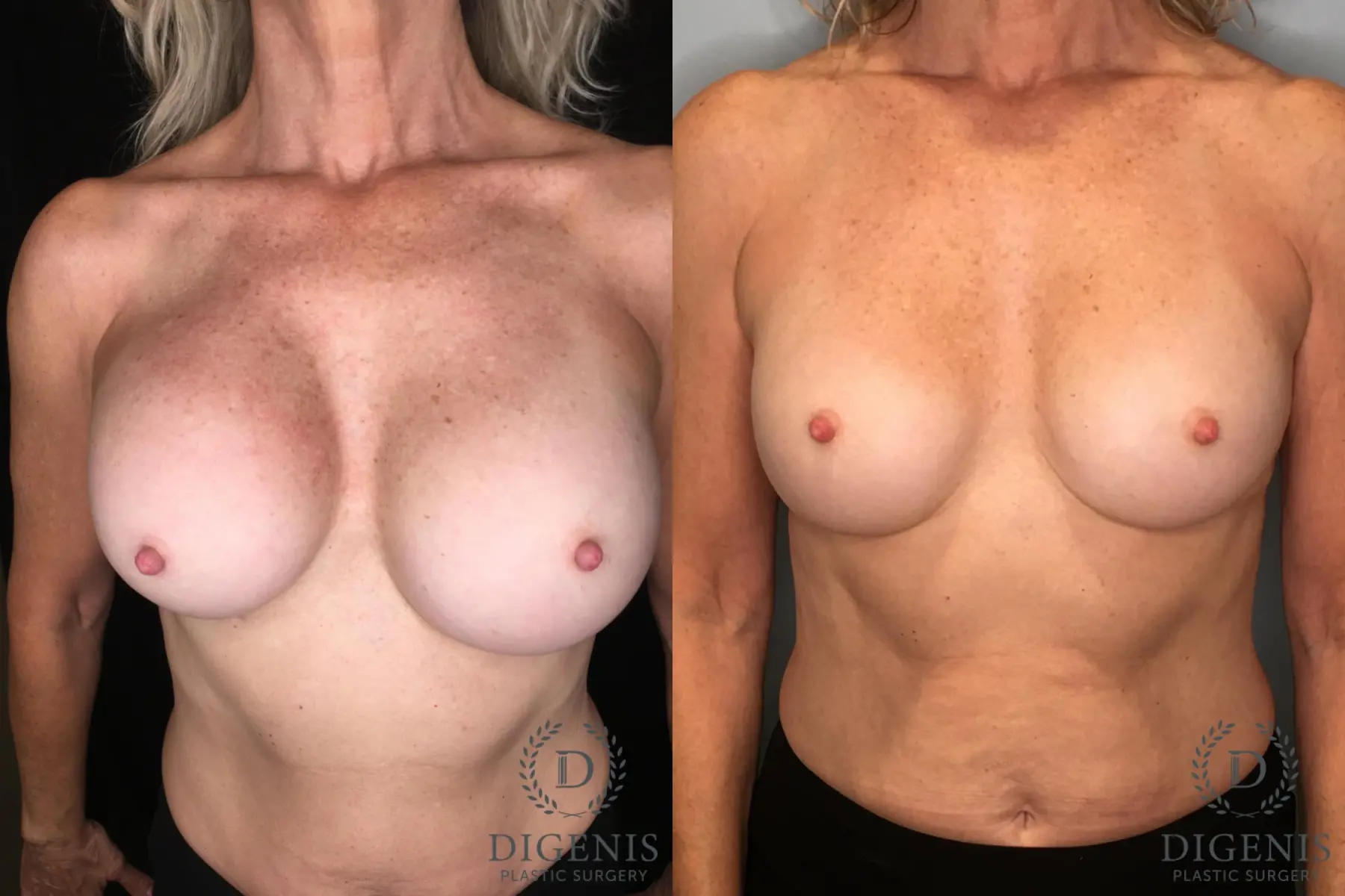 Breast Implant Exchange: Patient 5 - Before and After  