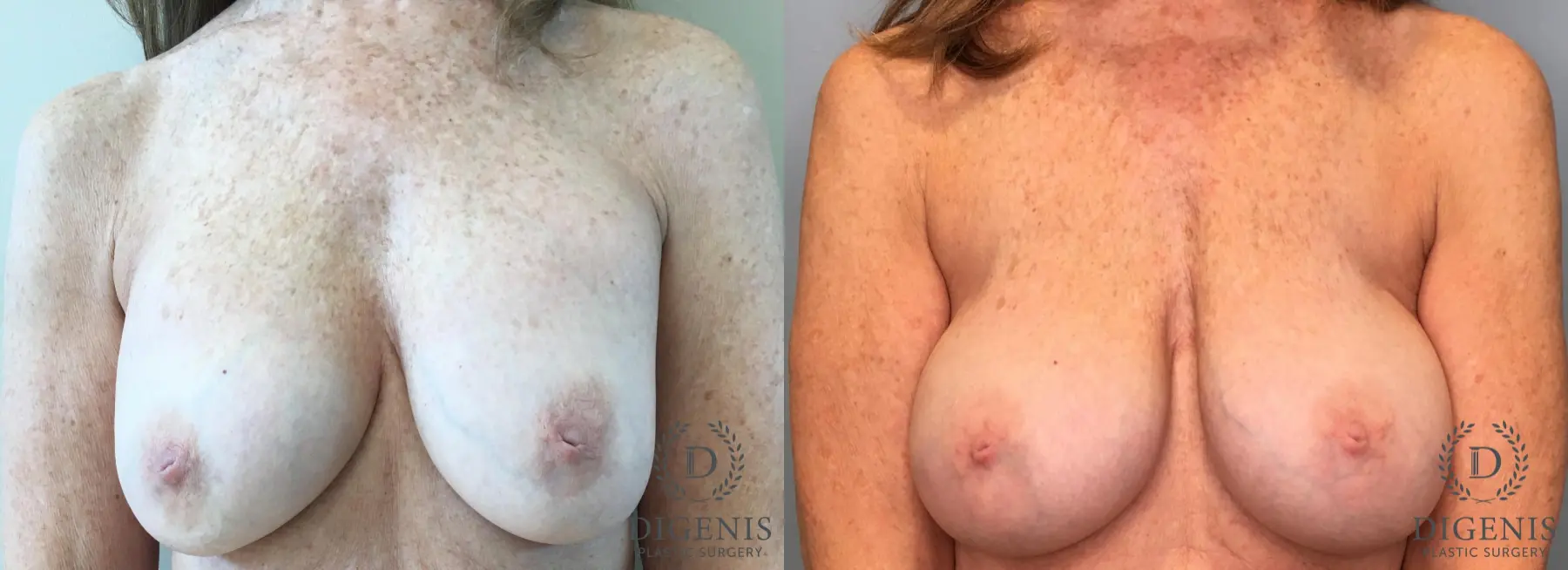 Breast Implant Exchange: Patient 8 - Before and After  