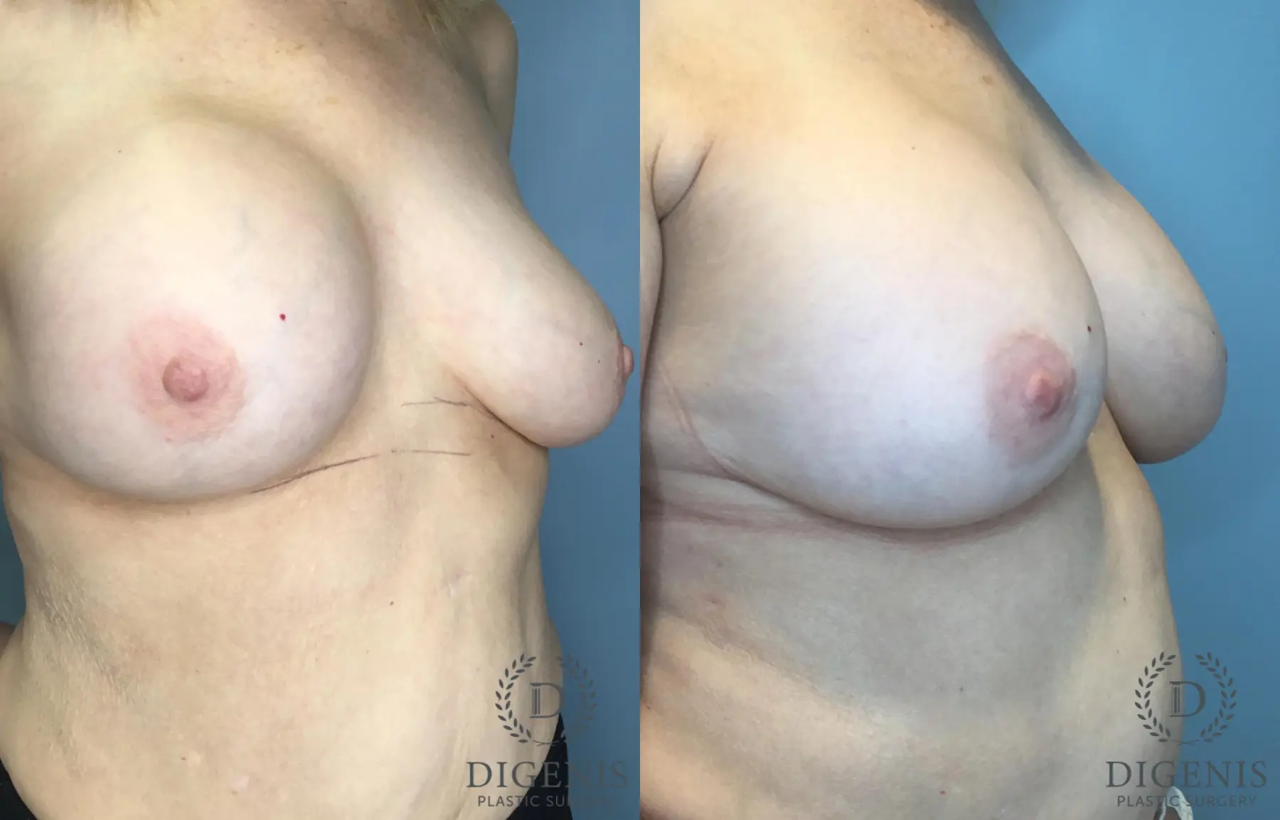 Breast Implant Exchange: Patient 2 - Before and After 4