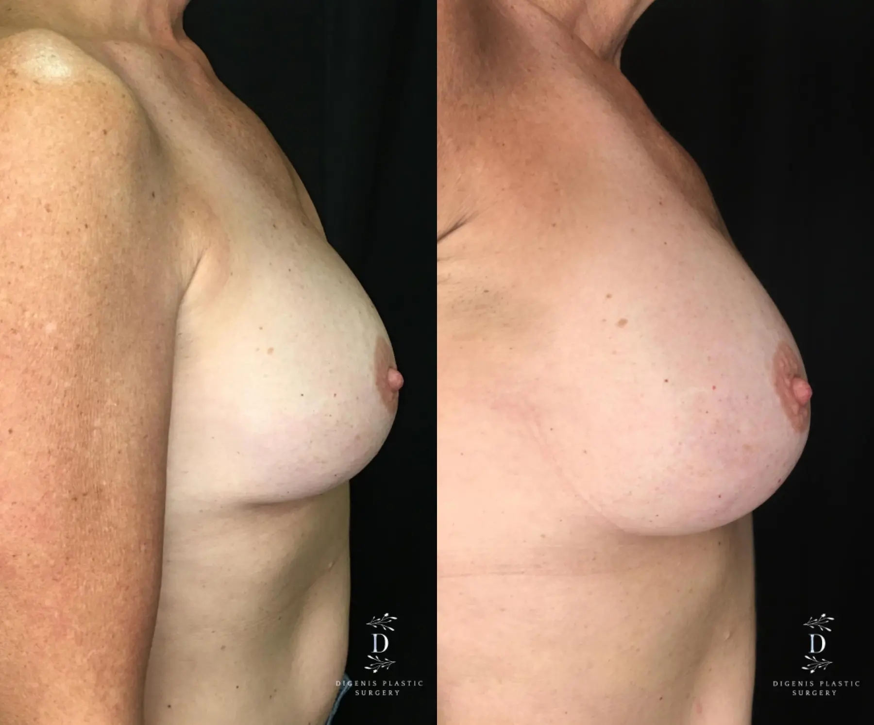 Breast Implant Exchange: Patient 3 - Before and After 3