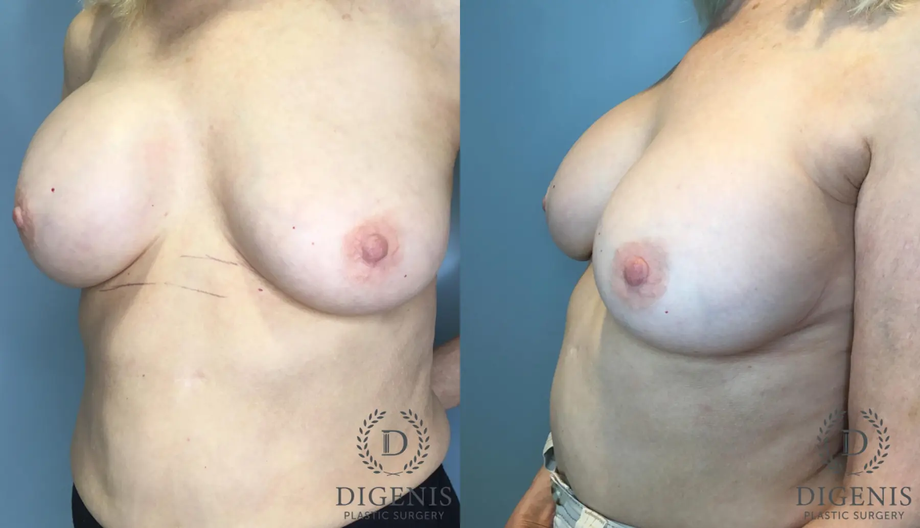 Breast Implant Exchange: Patient 2 - Before and After 2