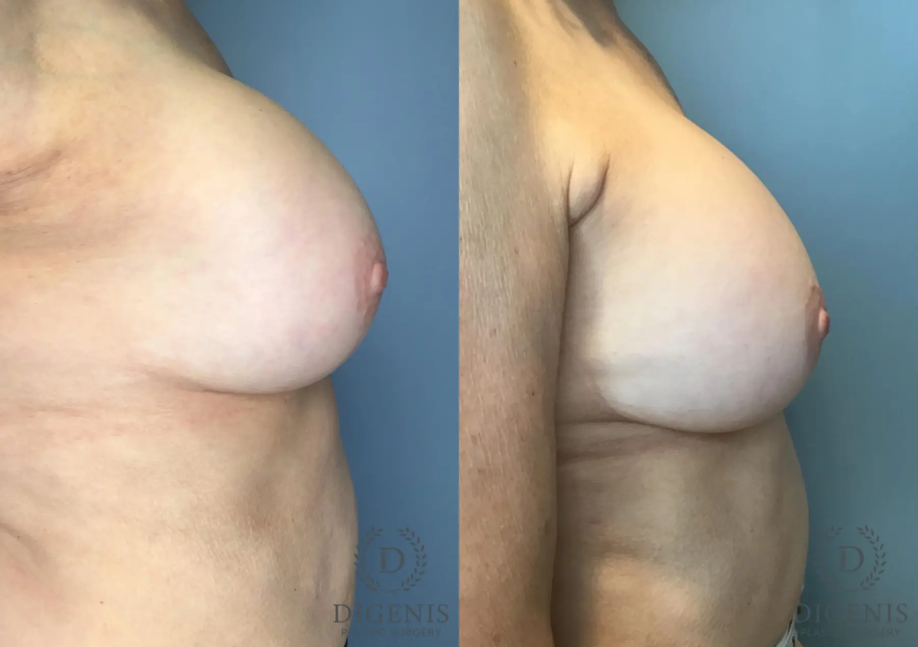 Breast Implant Exchange: Patient 2 - Before and After 5
