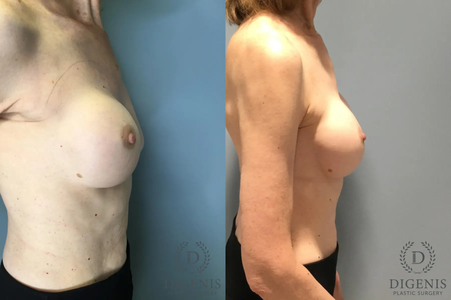 Breast Implant Exchange: Patient 1 - Before and After 5