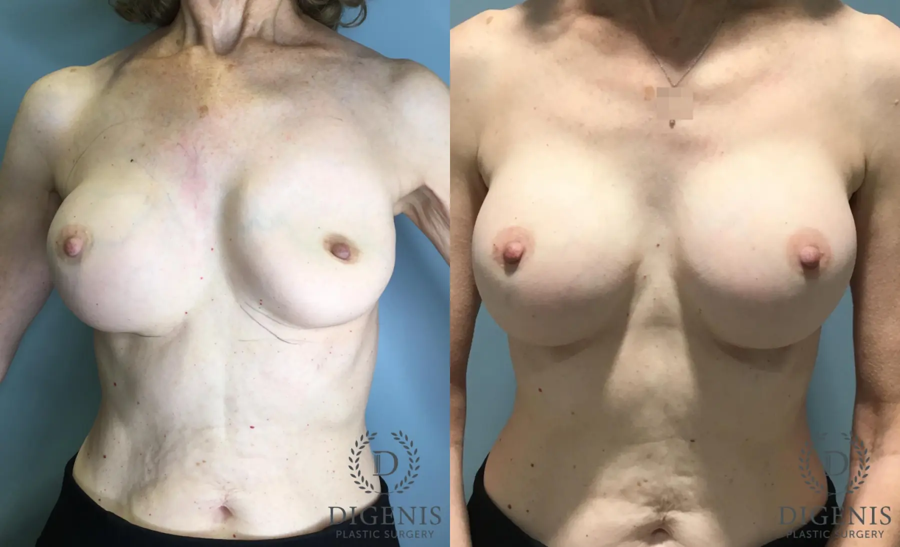 Breast Implant Exchange: Patient 1 - Before and After  