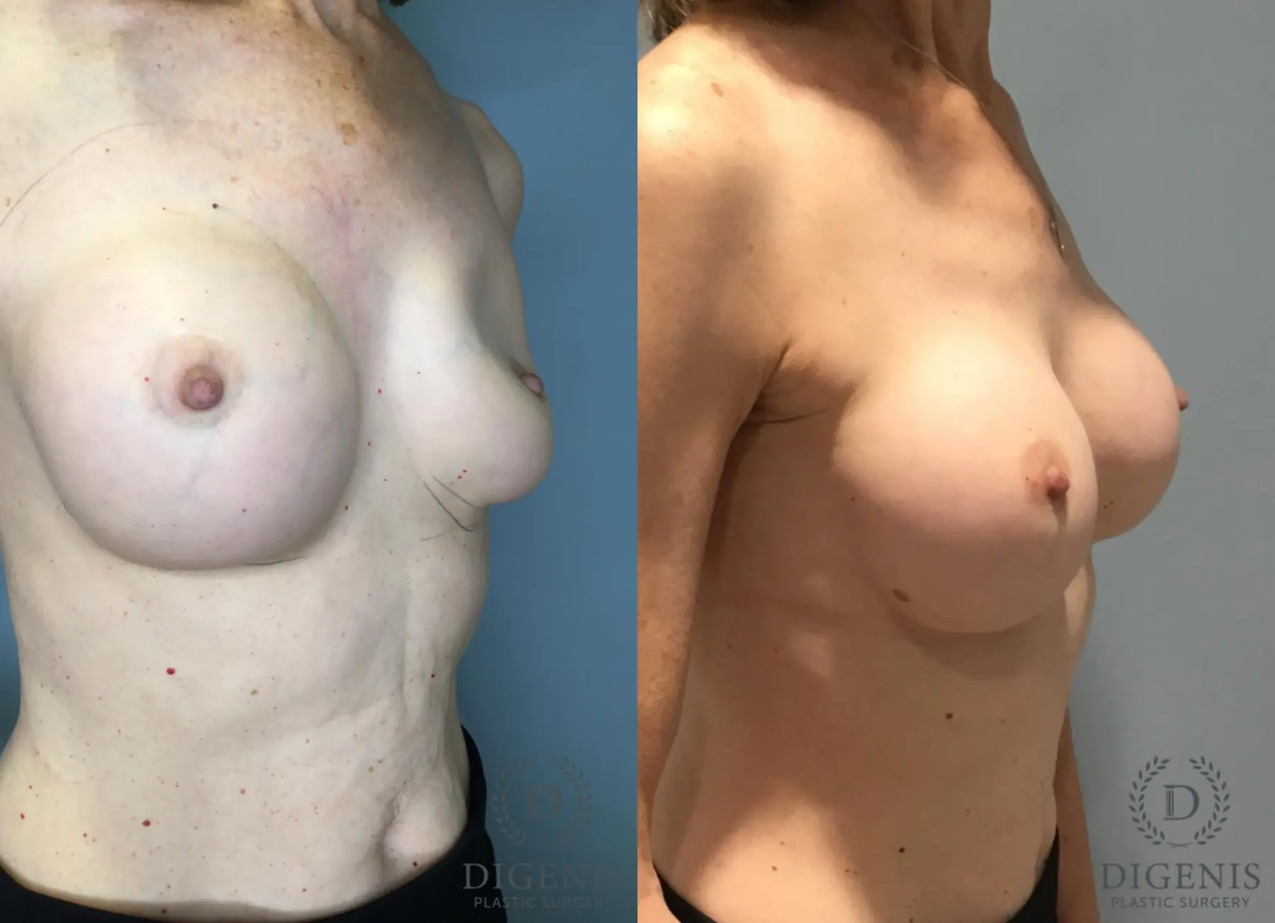 Breast Implant Exchange: Patient 1 - Before and After 4