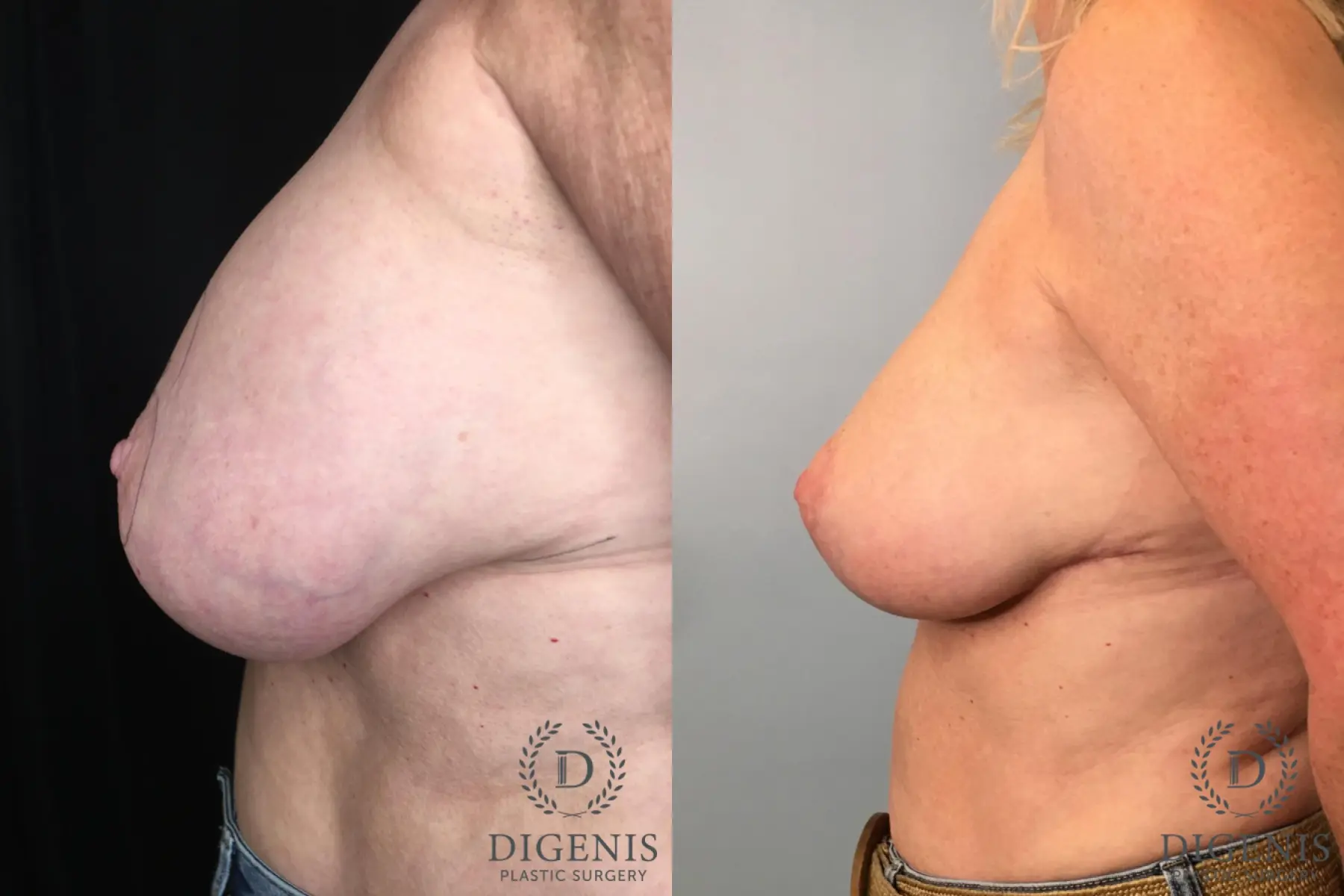 Breast Implant Removal With Lift: Patient 1 - Before and After 5