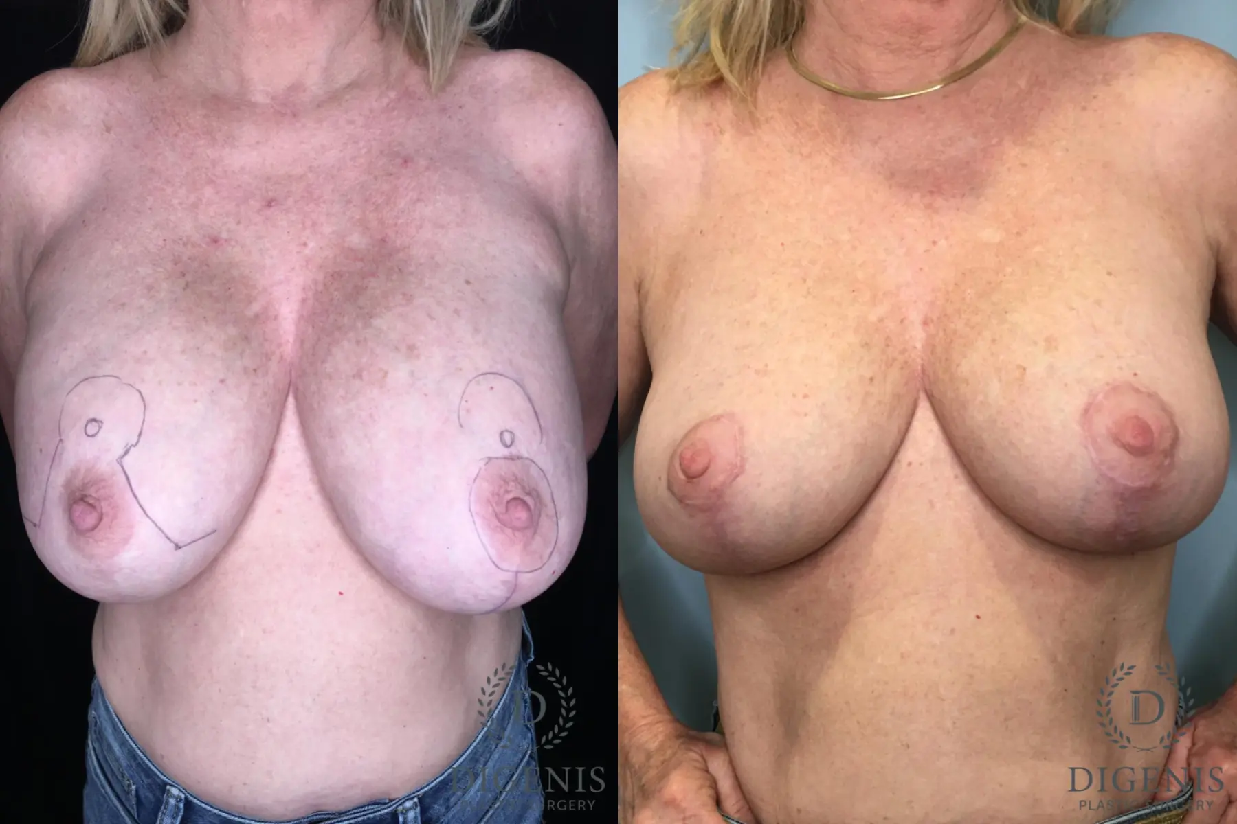 Breast Implant Removal With Lift: Patient 1 - Before and After  