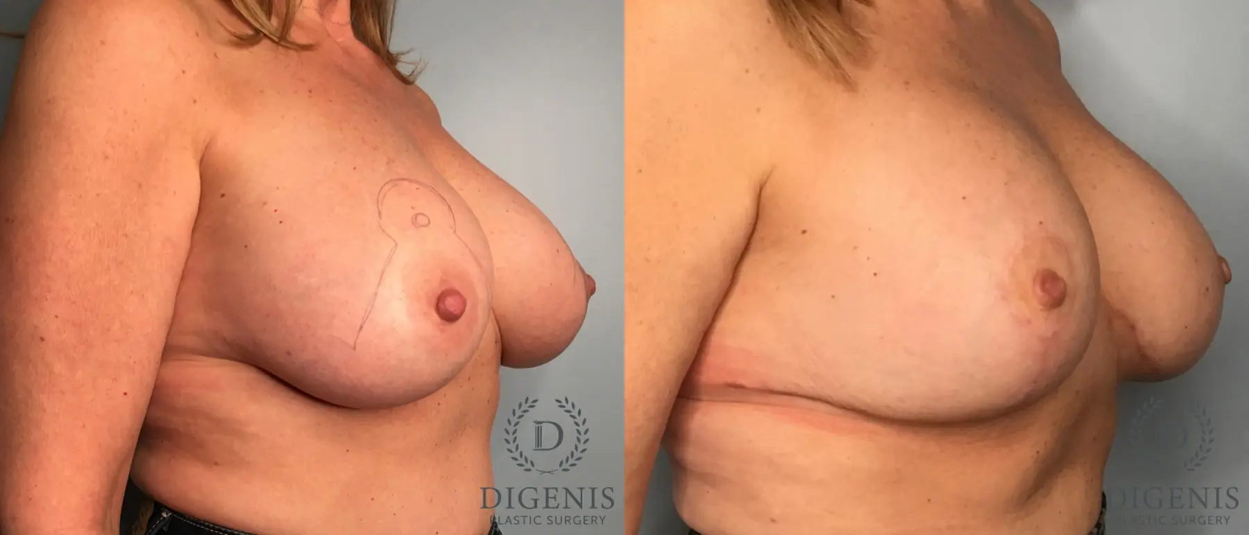 Breast Implant Removal With Lift: Patient 3 - Before and After  