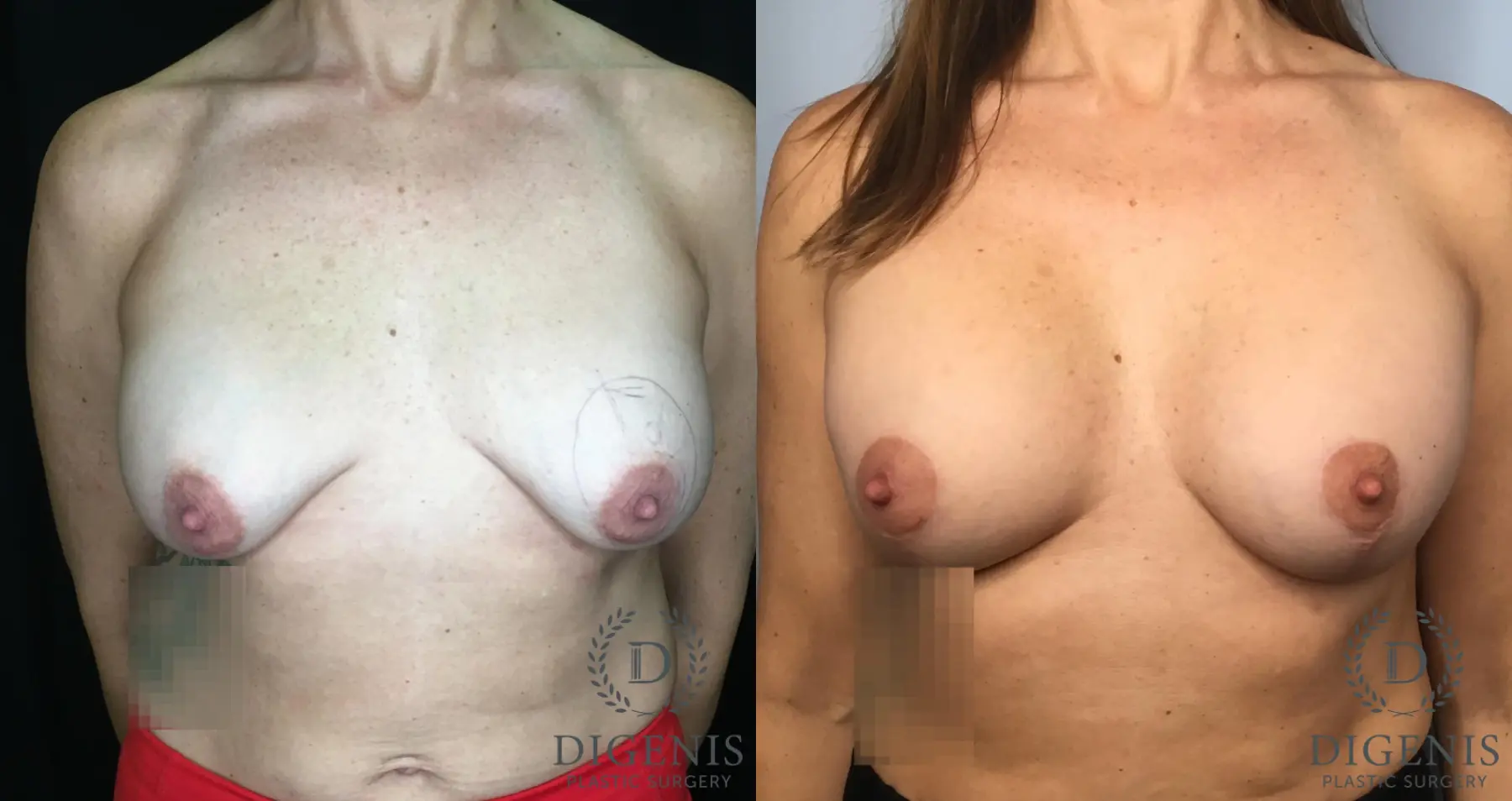 Breast Implant Removal With Lift: Patient 2 - Before and After  