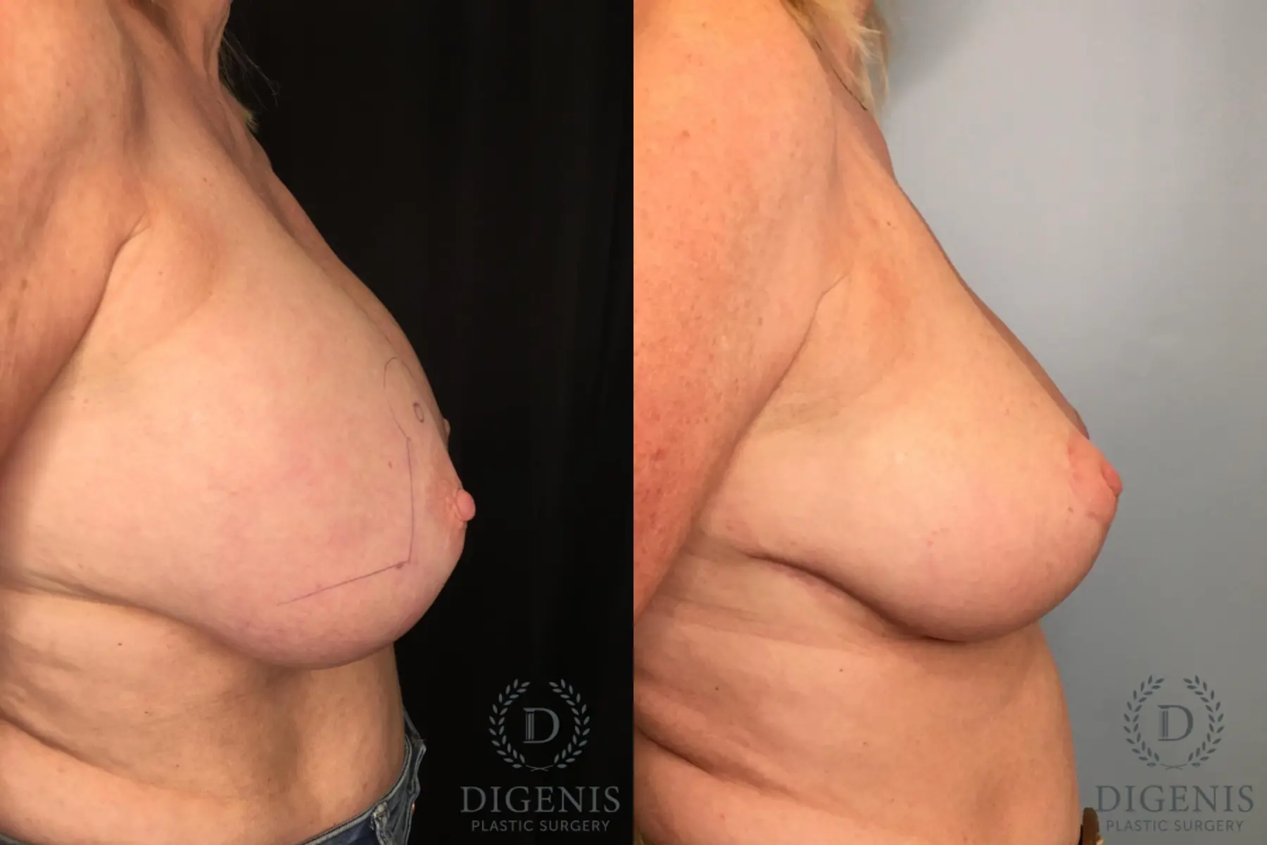 Breast Implant Removal With Lift: Patient 1 - Before and After 3