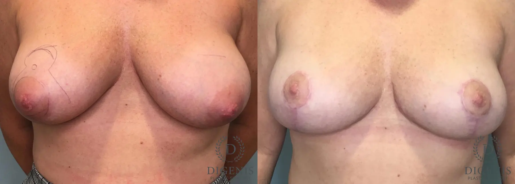 Breast Lift: Patient 42 - Before and After  