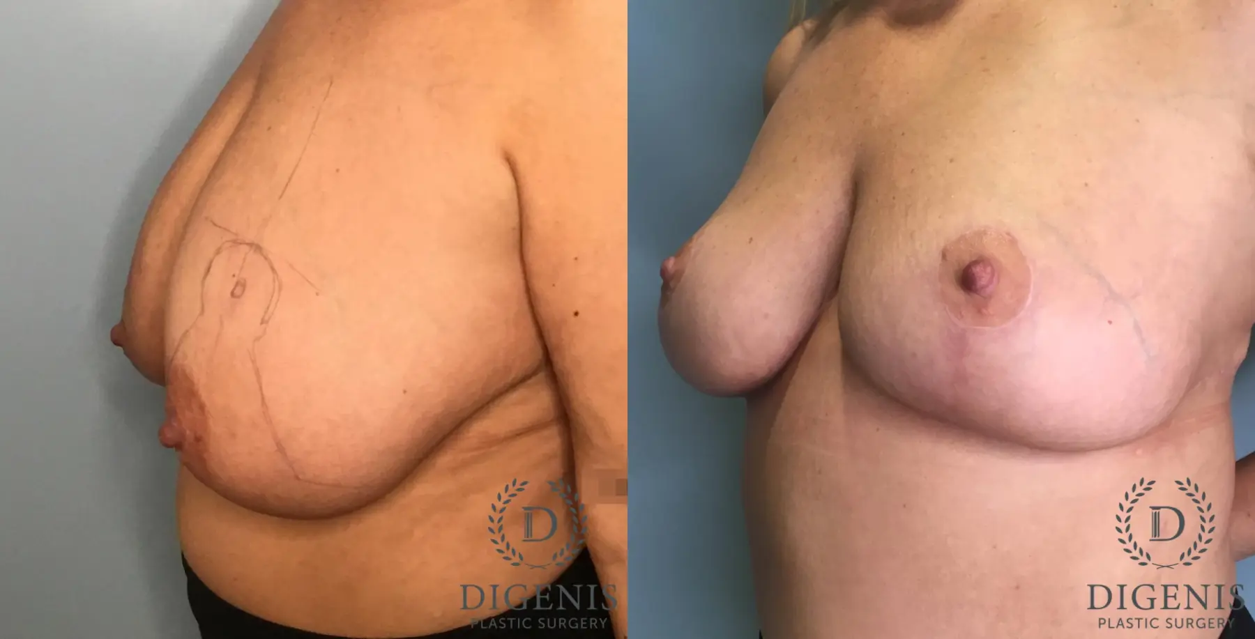 Breast Lift: Patient 44 - Before and After 4