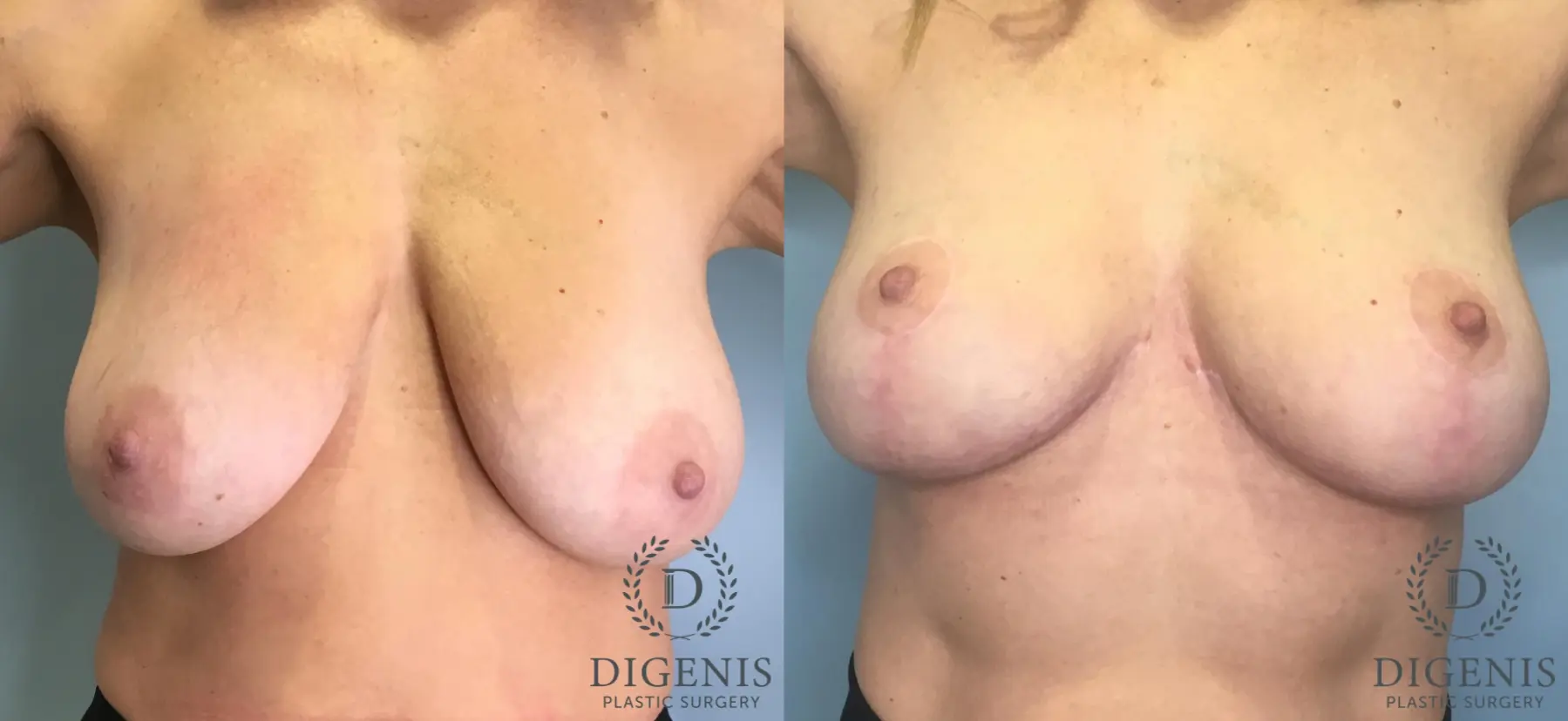 Breast Lift: Patient 5 - Before and After  