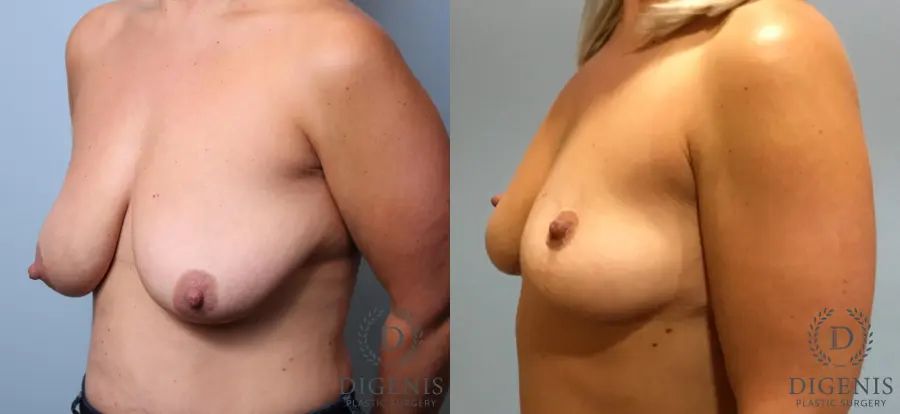 Breast Lift: Patient 4 - Before and After 4