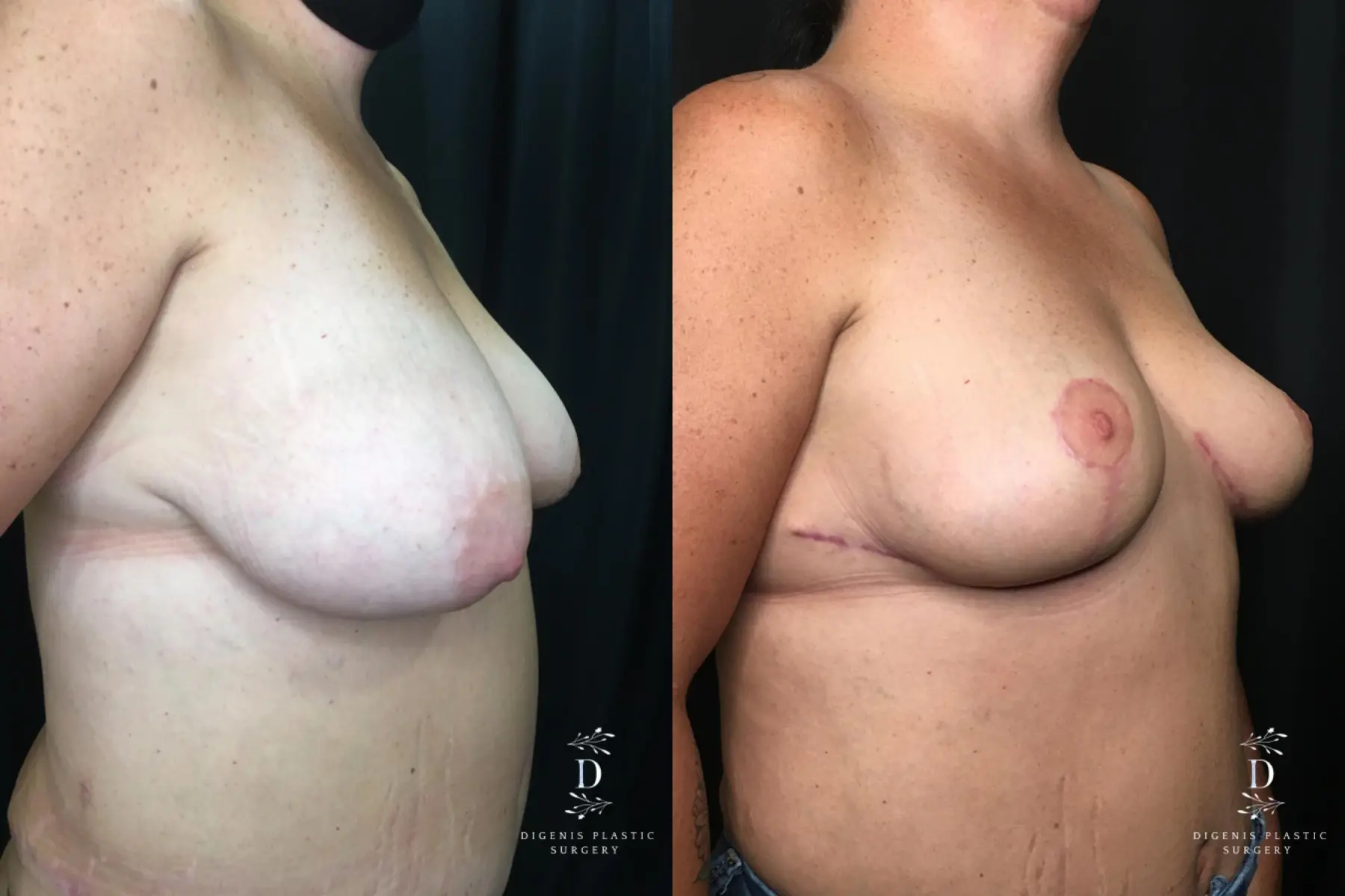 Breast Lift: Patient 10 - Before and After 2
