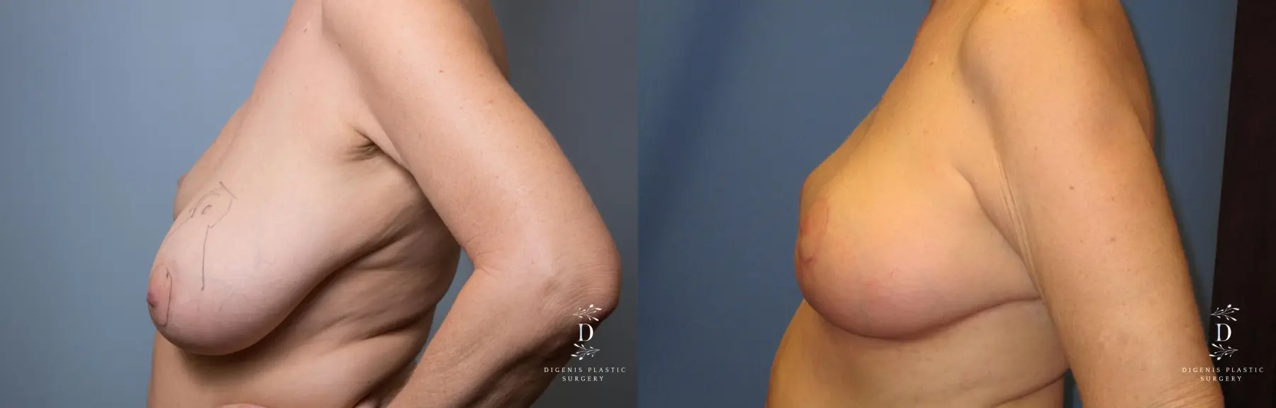 Breast Lift: Patient 6 - Before and After 5