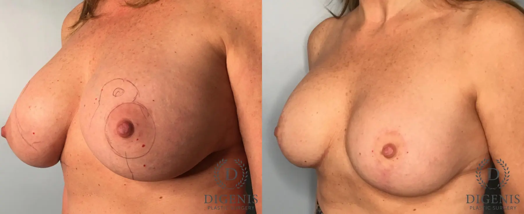 Breast Lift: Patient 38 - Before and After 3
