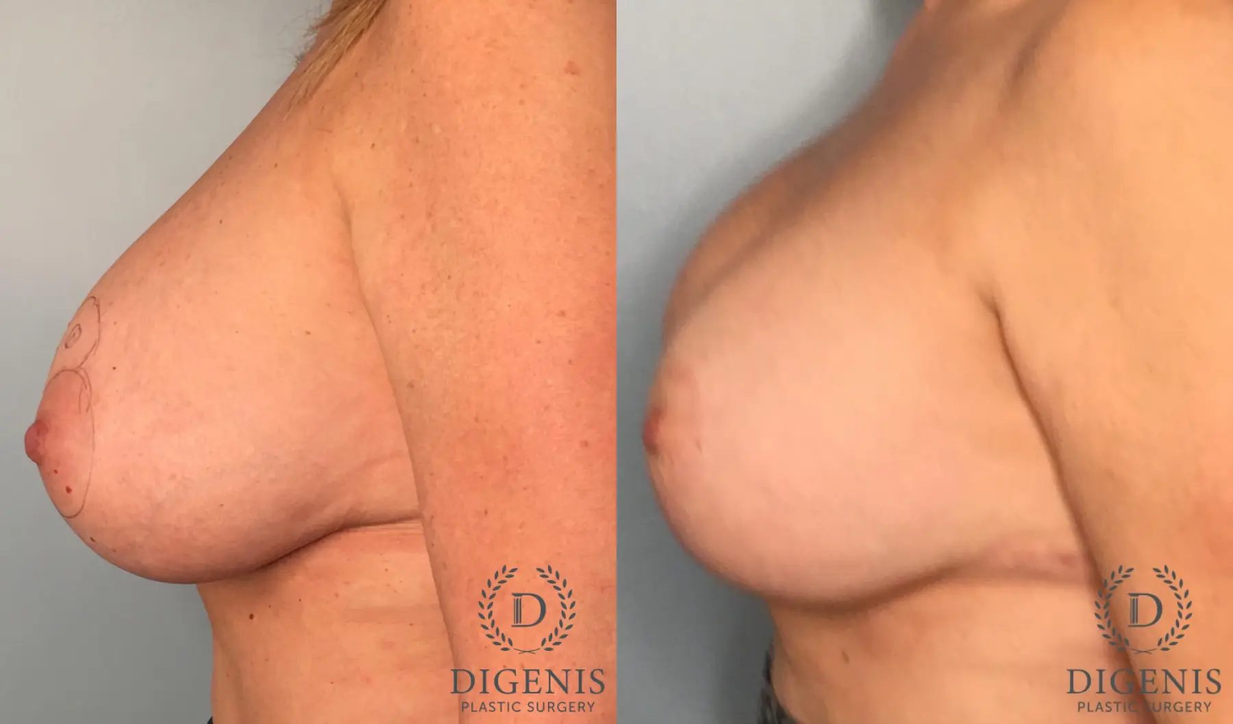 Breast Lift: Patient 38 - Before and After 4