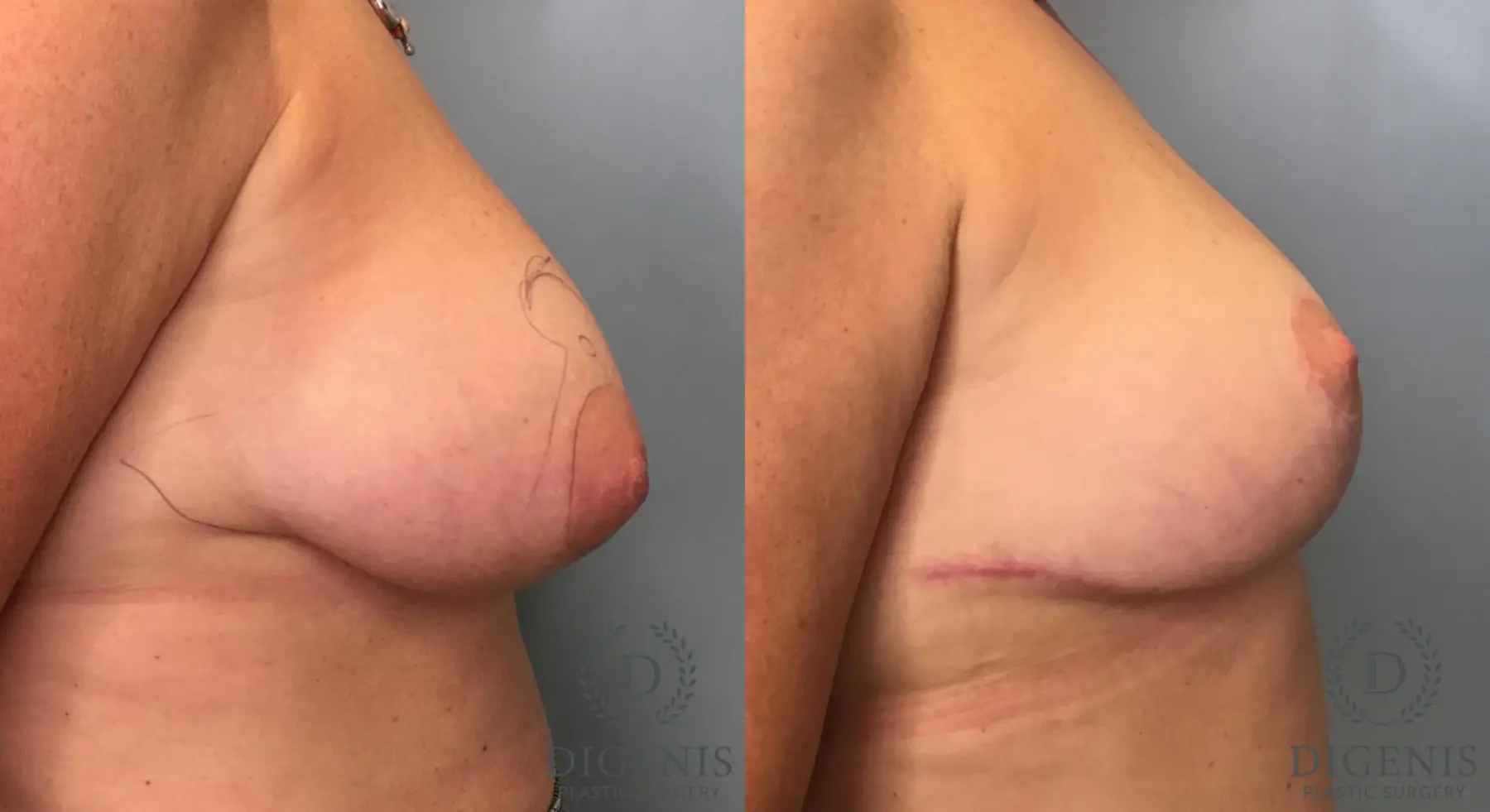 Breast Lift: Patient 42 - Before and After 3